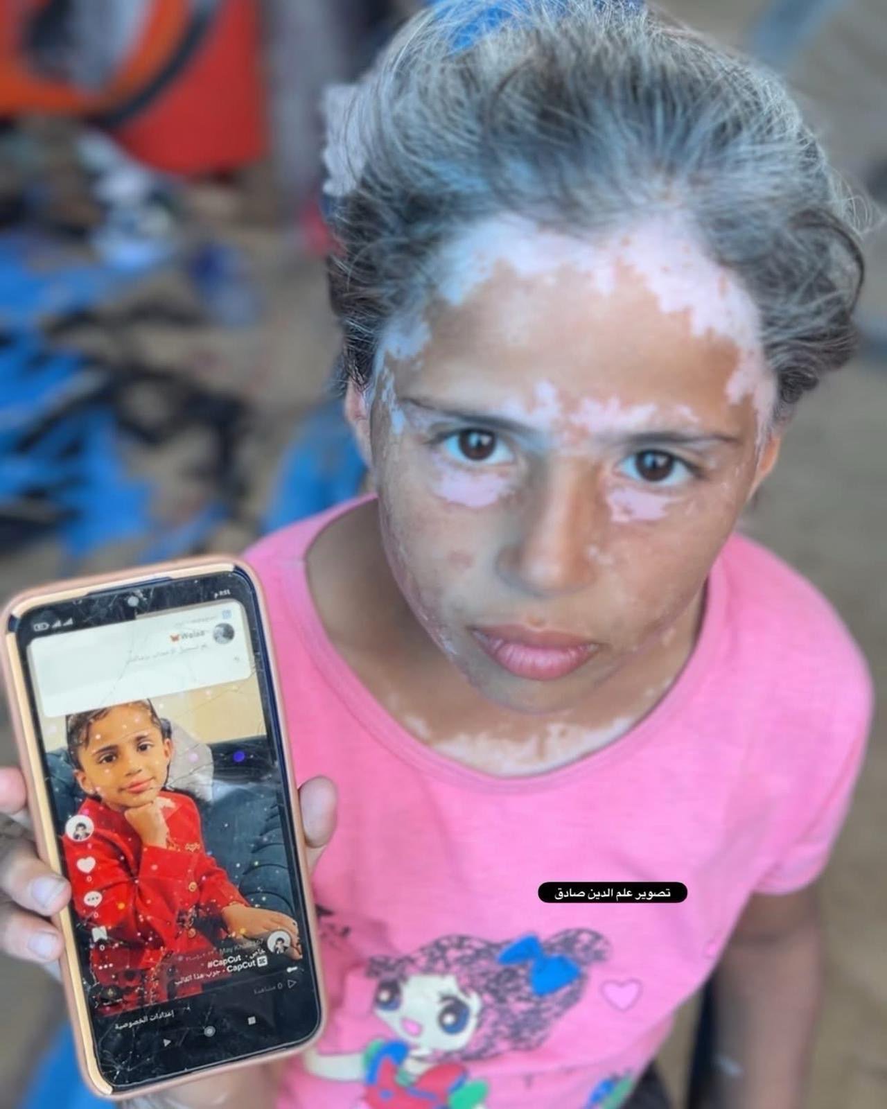 A girl who survived severe burns, holding a photograph of herself before the injury.